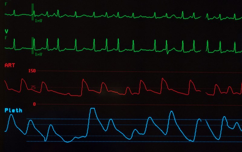 Tavr Program Should Your Organization Add a TAVR Program?